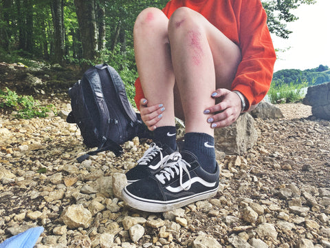 Girl scratching legs, sitting in forest