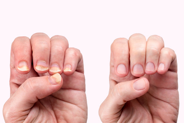 What happens when a thumb nail falls off? - Quora