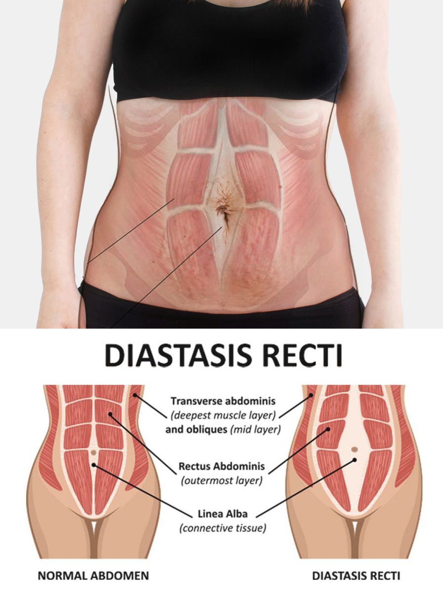 BS- These Leggings Can Help with Your Postpartum Diastasis Recti Separ –  Fanka