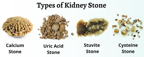 Types of kidney stone