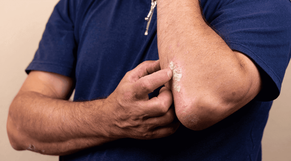 A White man in a blue shirt scratching an eczema rash on his arm. 