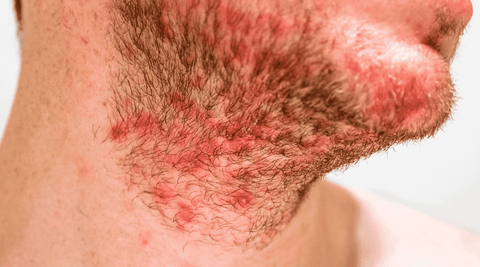 A white man's neck and beard with red little bumps caused by seborrheic dermatitis type of eczema.