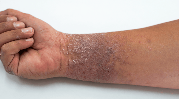 Black man with eczema on wrist. 