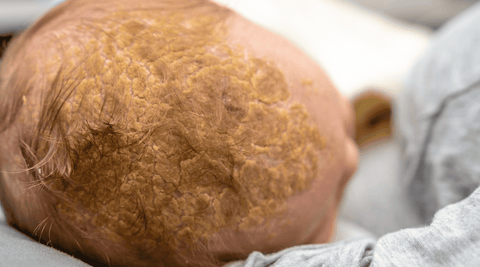 A blond baby's head with seborrheic dermatitis or cradle cap. 