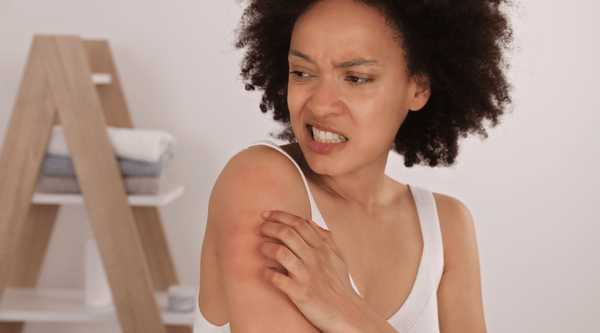 Black woman going through eczema itch-scratch cycle on her arm.