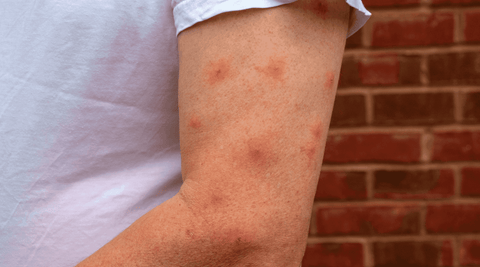 White man with a white tee shirt that has contact dermatitis from insect bites. 