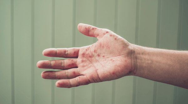 A white man's hand with dyshidrotic eczema. 