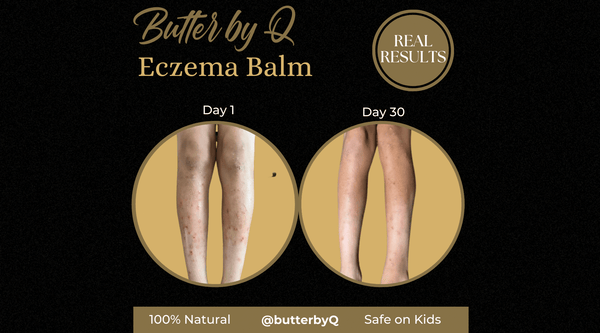 Before and after of Butter by Q's premium eczema balm in McDonough, GA 