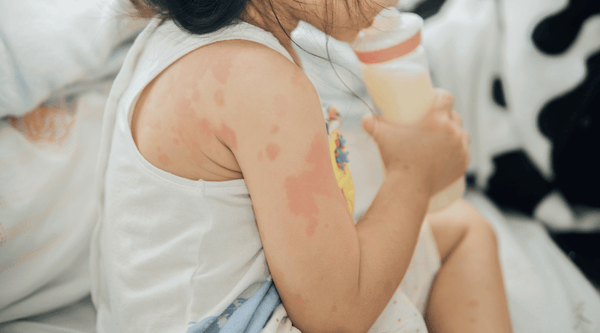 Child at a concert with atopic dermatitis on her arm. 