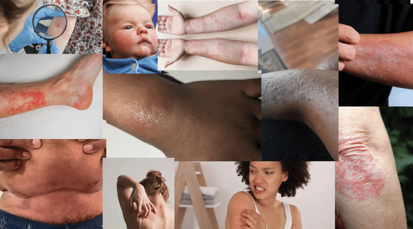 Collage of Eczema 