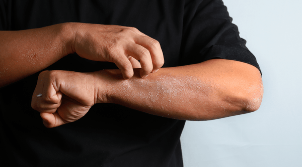 White man with eczema on forearm and dry skin.