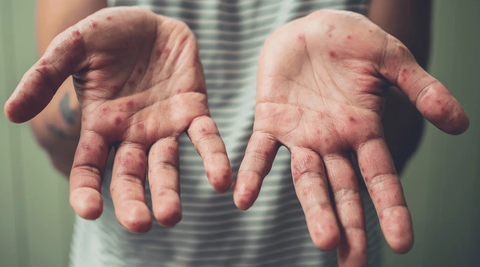 A white man with both hands showing dyshidrotic eczema. 