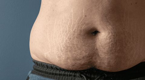 White man with deep white stretch marks on the abdomen and stomach from weight loss. 