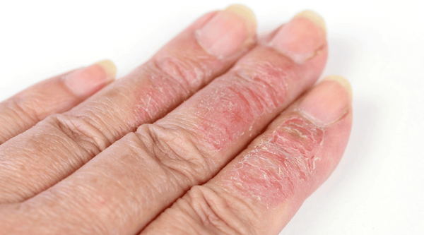 A white woman's hand with neurodermatitis type of eczema dermatitis. 
