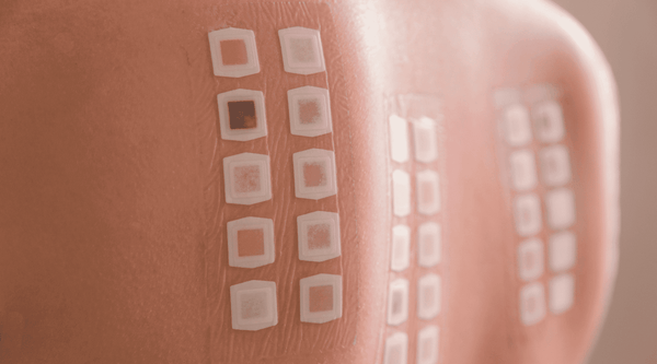 Image of a persons back with patch testing and allergy testing for atopic dermatitis. 