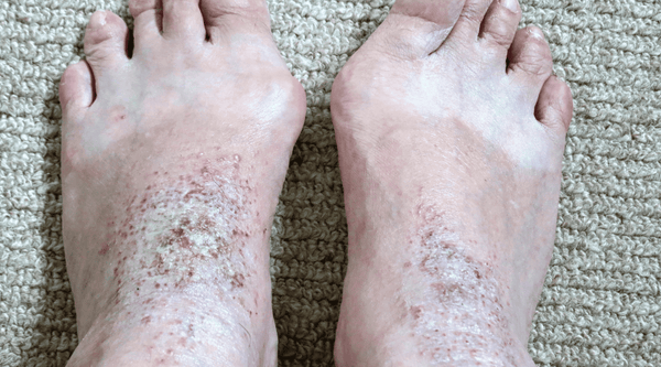 Image of white man's feet with stasis dermatitis type of eczema