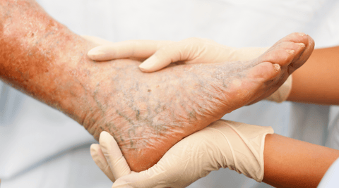 Image of white person's foot with varicose veins. 