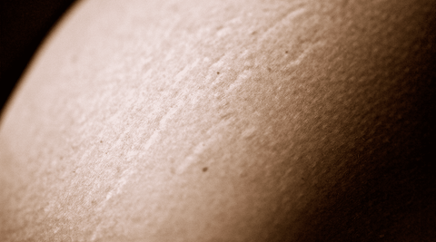 An up close image of stretch marks 