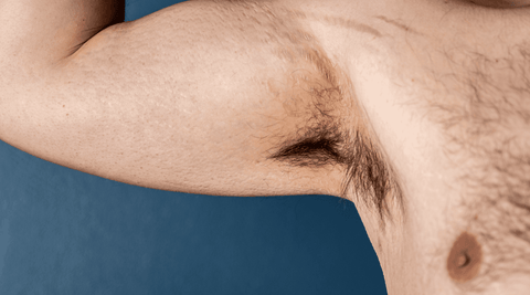 A white man with raised red stretch marks on his bicep and arm