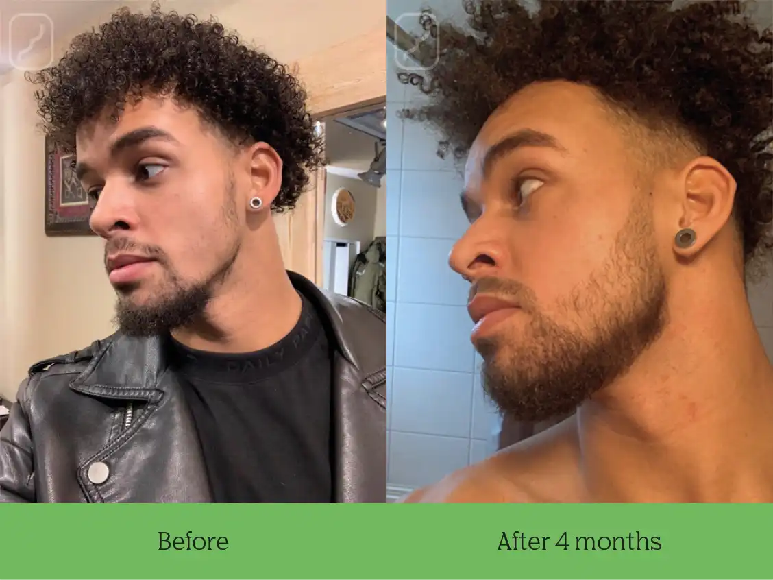 Neofollics beard growth serum before after results