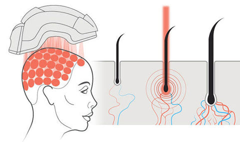 clinical strength lasers