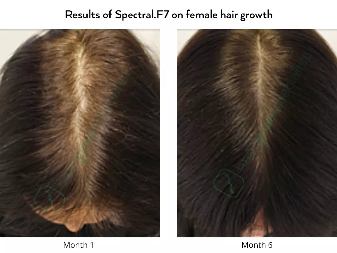 Resultat of Spectral.F7 on female hair growth