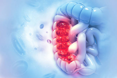 Colorectal Cancer: Understanding the Disease and Treatment Options