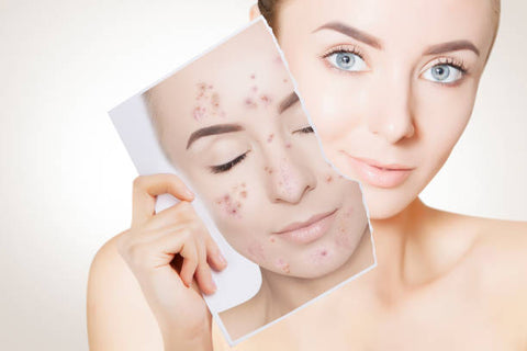 What are the signs and treatment options for common skin conditions like acne or eczema?