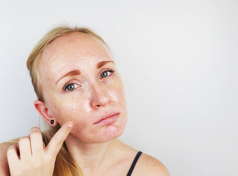 How to Manage Oily Skin?