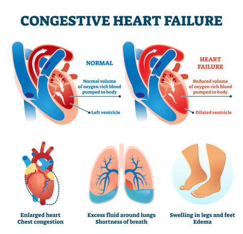 Congestive Heart Failure: Causes, Symptoms, Treatment, and Prevention