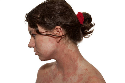 What are the signs and treatment options for common skin conditions like acne or eczema?