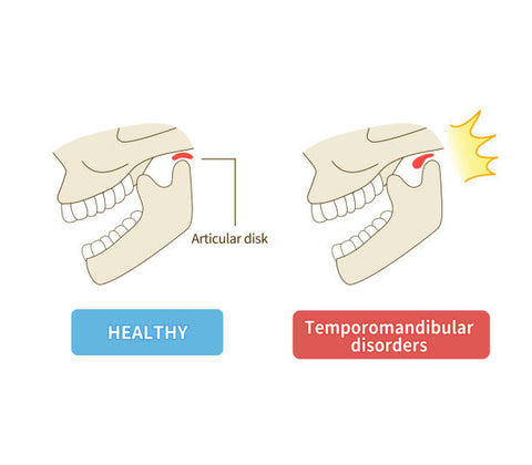 Temporomandibular Joint Disorder/TMJ Disorder: Everything You Need to Know