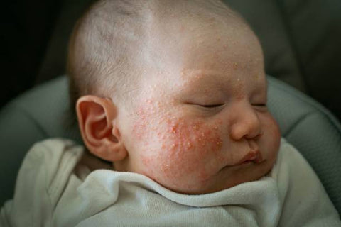 How do you identify and treat common skin conditions in babies?