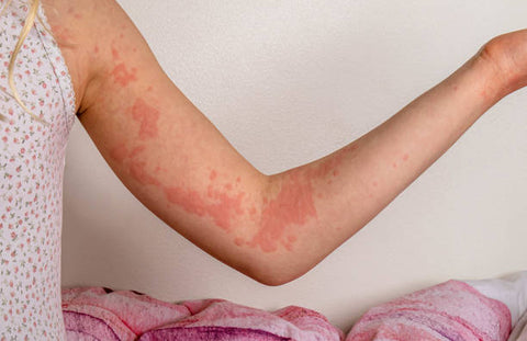 Understanding Hives: Causes, Symptoms, and Simple Remedies