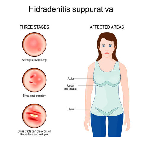 An Overview of Hidradenitis Suppurativa