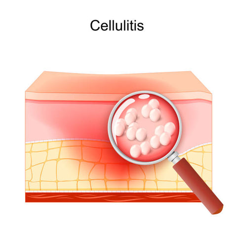 Cellulitis: Causes, Symptoms, and Treatment Options