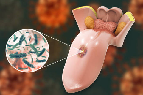 What is Squamous Cell Carcinoma? Information, Causes, Diagnosis and Treatments