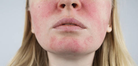 Rosacea: Understanding the Symptoms, Treatment and Management