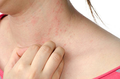 How to Recognize the Symptoms of Contact Dermatitis