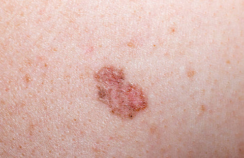 A Comprehensive Guide to Basal Cell Carcinoma: Symptoms, Causes, Diagnosis and Treatment