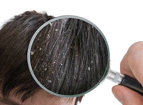 Dandruff: Causes, Treatments and Home Remedies