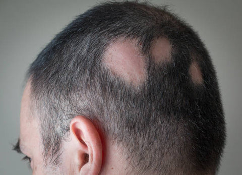 Understanding Alopecia: Causes and Treatments