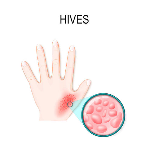 Understanding Hives: Causes, Symptoms, and Simple Remedies