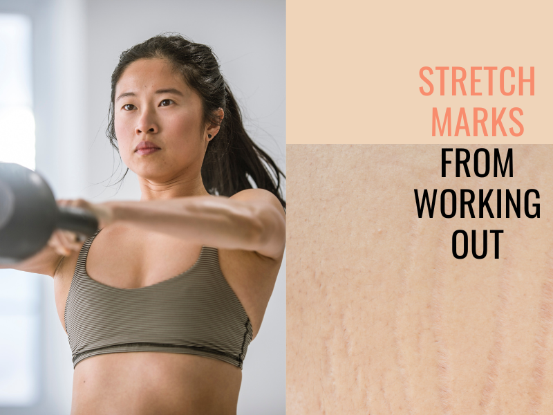 Can Exercise Reduce The Appearance Of Stretch Marks?