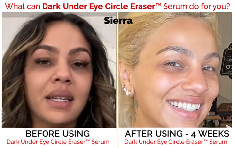 Before - After Woman with Dark Under Eye Circles - Beauty Of The Nile