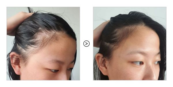 Hair Fall Treatment Oil