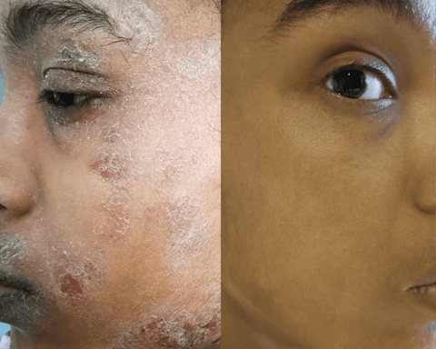 avant et après l'état de la peau