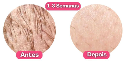 Depilador Laser Permanente Profissional Definitivo