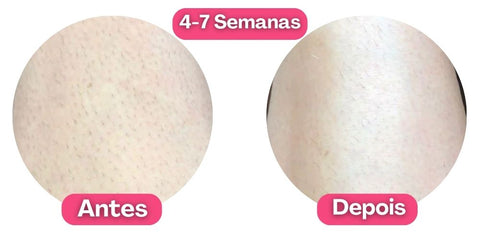 Depilador Laser Permanente Profissional Definitivo