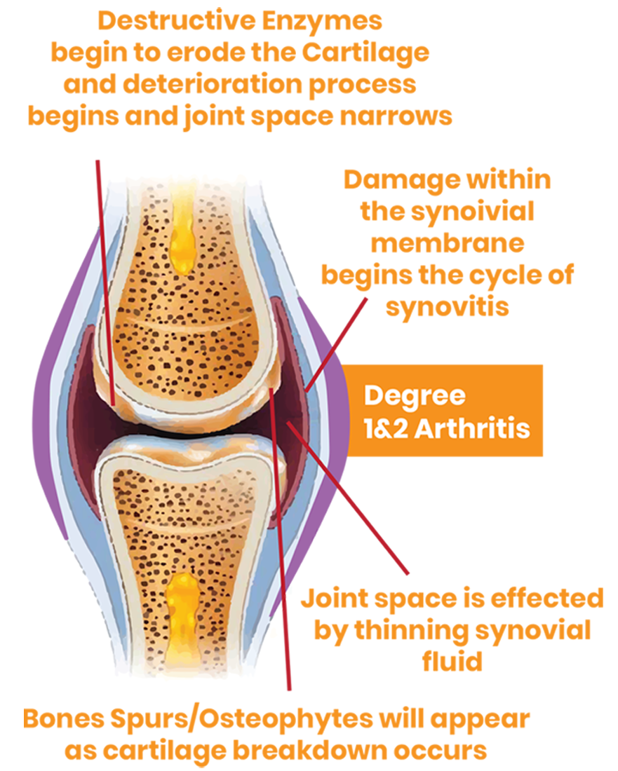 2-3 degrees of arthritis